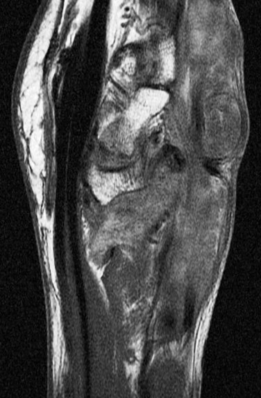 Figure 4 for case Rheumatoid arthritis ( RID3561 )